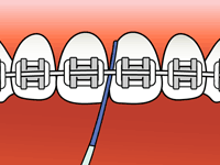 flossing-1