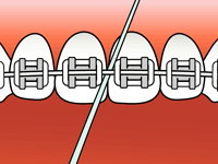 flossing-2