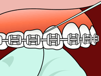 flossing-3