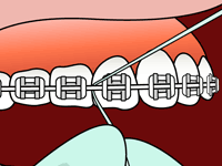 flossing-4